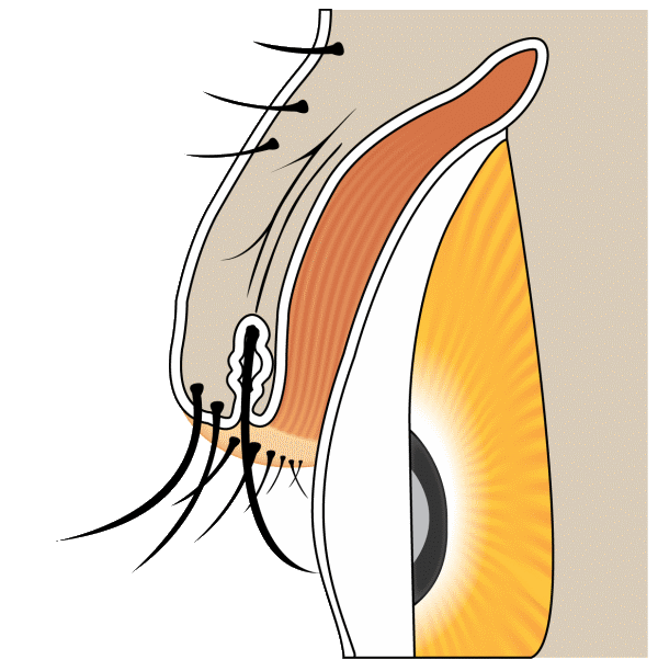 Distichiasis &mdash; second row of eyelashes