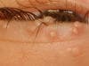 Molluscum contagiosum &mdash; close-up of eyelid papules