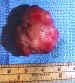 Orbital tumor causing proptosis